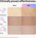 Braun Smart IPL Skin iexpert PL7253 IPL-apparat