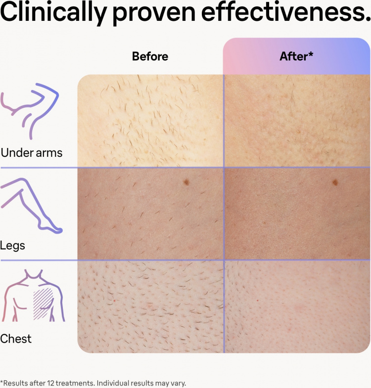 Braun Smart IPL Skin iexpert PL7253 IPL-apparat